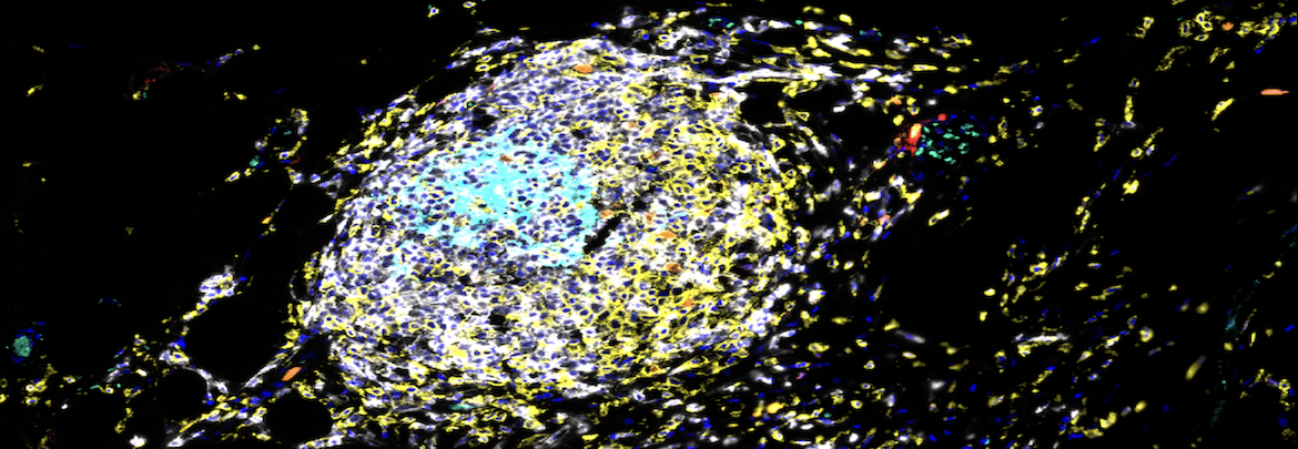 Multispectral imaging captures hallmarks of tertiary lymphoid structures (TLS)